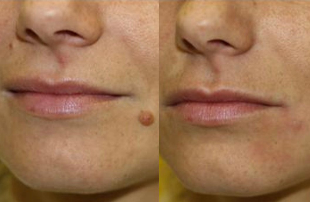 Before and After transformation